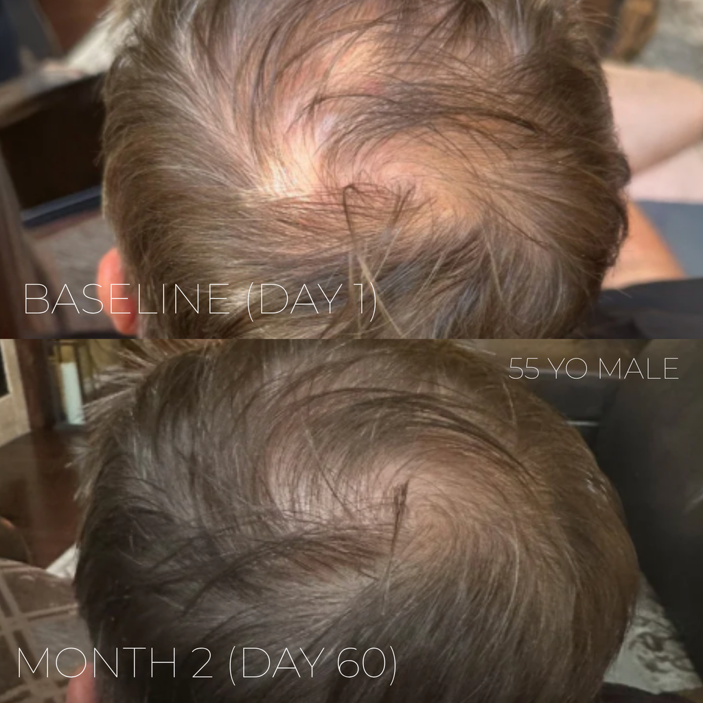 Xtresse Hair Growth Gummies